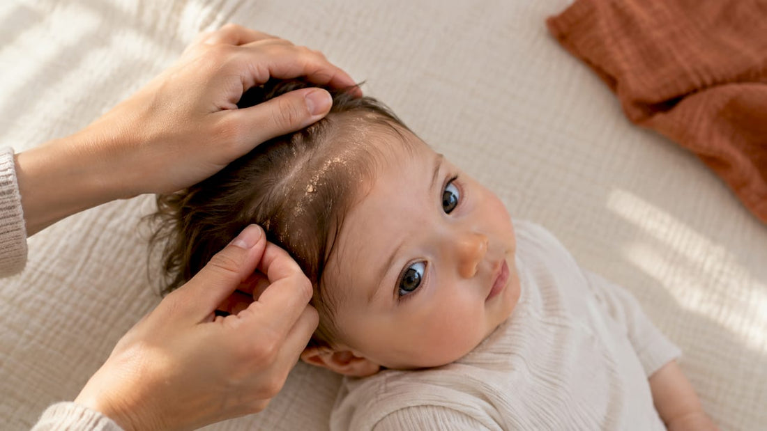 Baby scalp with visible cradle cap flakes